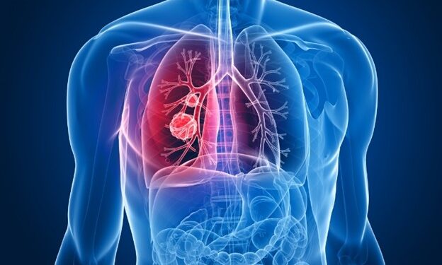 सुरुवाती चरणमै क्यान्सर पत्ता लागे निको हुन्छ