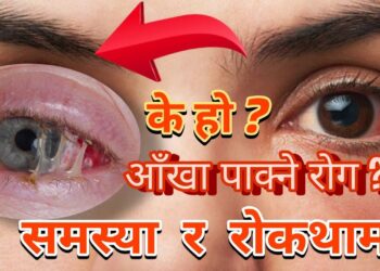 आँखा पाक्ने रोग फैलियो , कसरी जोगिने ?